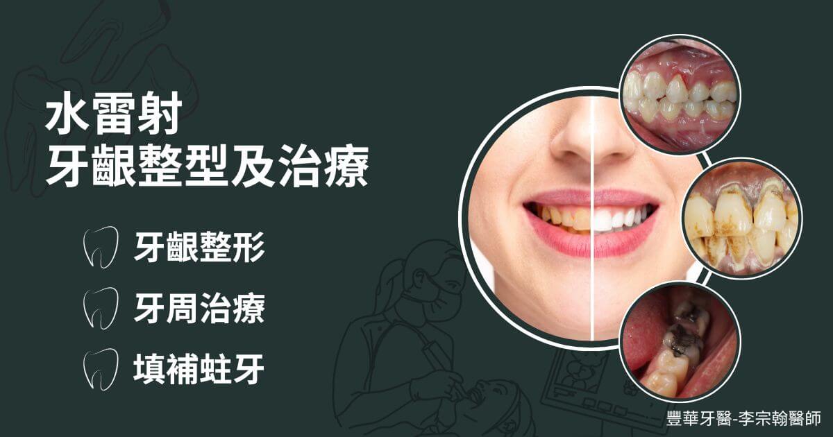 台北水雷射牙齦整型及牙周治療推薦-李宗翰醫師